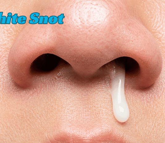White Snot: Complete Guide to Causes, Meaning, Symptoms, Treatments, Home Remedies, Prevention Tips, When to Seek Medical Help, and Sinus Health White Snot